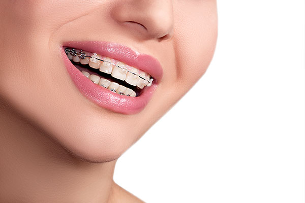 What Takes Longer: Clear Aligners or Braces? - Orange Coast