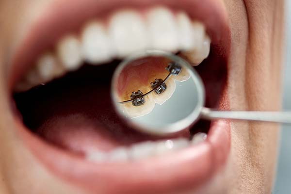Lingual Braces Are A Discreet Teeth Straightening Treatment